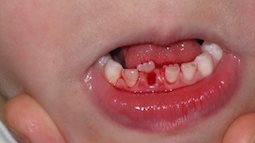 Bác sỹ nha khoa cảnh báo 2 trường hợp bố mẹ không nên tự nhổ răng sữa cho con tại nhà