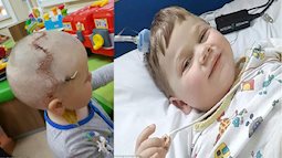 Xót xa bé trai 7 tháng tuổi phải phẫu thuật mở hộp sọ vì căn bệnh hiếm gặp