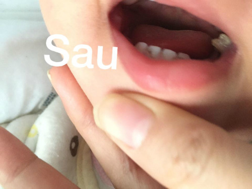 Răng của bé trắng hơn sau một tuần vệ sinh bằng hỗn hợp nước muối sinh lý và giấm táo.