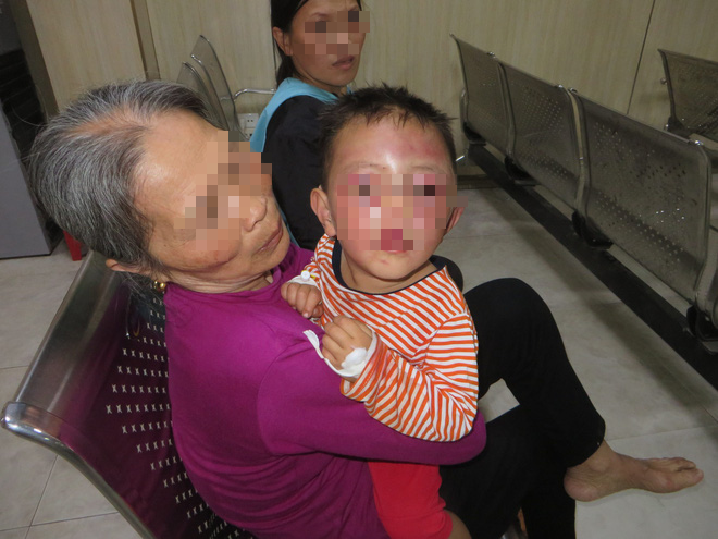 Nghệ An: Nghi vấn bé trai 2 tuổi bị cha dượng bạo hành khiến mặt mũi sưng phù, bầm tím - Ảnh 1.