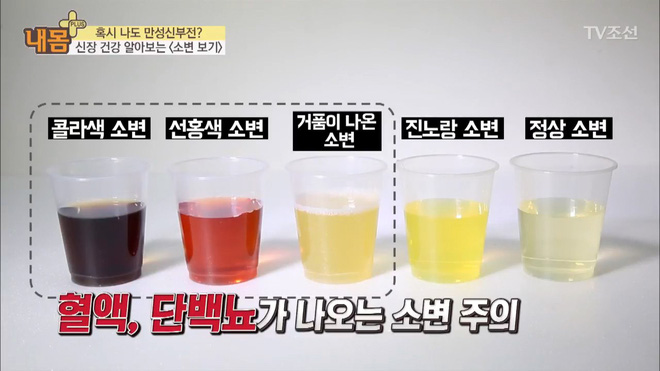 Bác sĩ Hàn Quốc hướng dẫn cách nhìn tình trạng nước tiểu xác định xem cơ thể đang mắc bệnh gì - Ảnh 8.