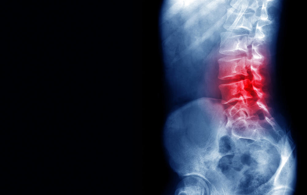 Đi tiểu nhiều kết hợp đau lưng là dấu hiệu của hội chứng đuôi ngựa.