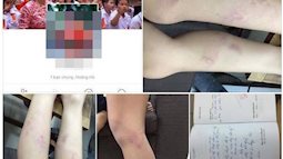 Hà Nội: Giáo viên chủ nhiệm lớp 2 bị tố đánh học sinh bầm tím chân