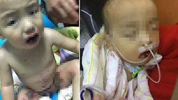 Ăn nhầm thuốc tẩy, bé trai 1 tuổi bị bỏng nặng khắp người 