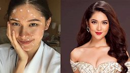 5 ngày trước chung kết Miss International 2017, Á hậu Thùy Dung bất ngờ nhiễm thủy đậu
