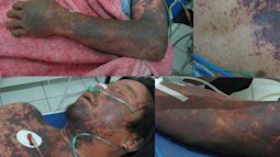 Ám ảnh vết loang tím đỏ trên da bị hoạị tử của bệnh nhân vào viện vì ăn thịt lợn
