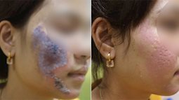 Hà Nội: Dùng kem trộn, một phụ nữ bị "lột sạch" da mặt, chỉ phục hồi được 30-40% sau điều trị
