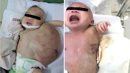 TP.HCM: Vừa chào đời, bé gái đã mang khối u khủng trên cơ thể khiến tính mạng nguy hiểm