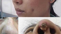 Lồi mũi, liệt cơ mí, lủng má vì làm đẹp dịp Tết