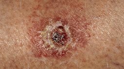 Đột nhiên nổi vết sưng đỏ, sần sùi trên da: Cảnh giác ung thư