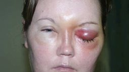 Cảnh báo: Kính áp tròng bạn đang đeo có thể gây loét giác mạc, mù mắt vì lý do này
