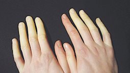 Đã mặc đồ ấm mà chân tay vẫn tê bì, lạnh cóng: Đừng chủ quan, coi chừng bệnh hiểm