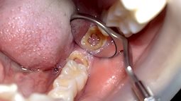 Nha sĩ Úc chỉ ra lý do đánh răng tỉ mỉ hàng ngày vẫn bị sâu răng