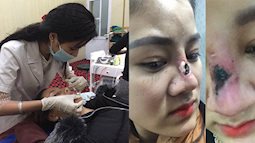 Bắc Giang: Phẫu thuật nâng mũi hỏng, cô gái 9X bị hở cả sụn, mũi gần như hoại tử