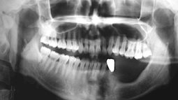 Cảnh báo: Bị đau răng chần chừ không đi khám, đến khi không chịu được thì đã hoại tử hàm