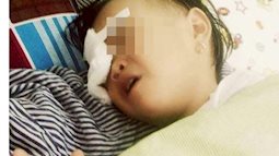 Bé gái 2 tuổi ở Nghệ An bị gà mổ mù mắt