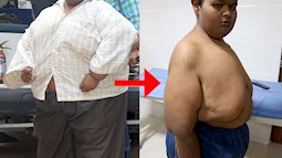 Chịu phẫu thuật để giảm cân, cậu bé giảm 70kg sau 1 năm điều trị