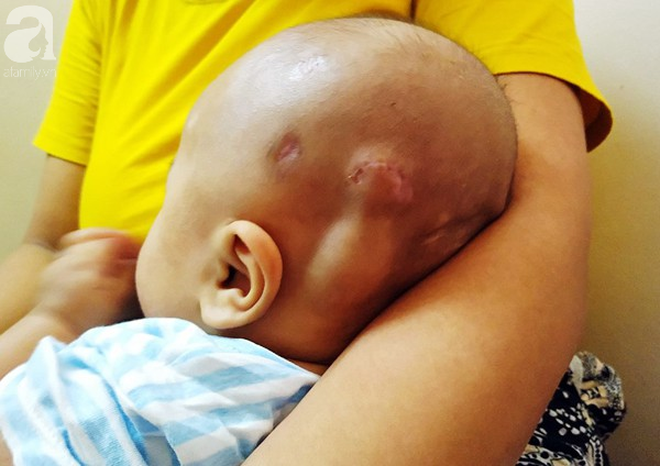 Tiếng khóc xé lòng của bé trai hơn 5 tháng tuổi mắc bệnh não úng thủy - Ảnh 7.