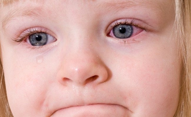 Bệnh đau mắt đỏ rất thường gặp ở trẻ nhỏ