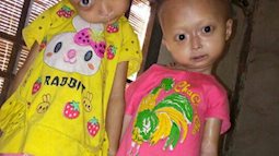 Tuyên Quang: 2 chị em gái mắc bệnh lạ khiến đầu, cổ bị nghẹo tựa "người ngoài hành tinh" khiến ai nhìn cũng xót xa