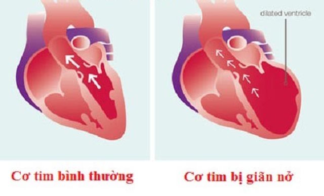 Căn bệnh nào được xem là 'ung thư của tim'? hình ảnh