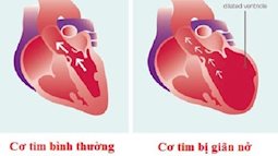 'Tử bệnh' của tim: cơ tim thể giãn