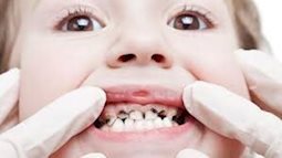 Cách ngăn ngừa và điều trị sâu răng hiệu quả