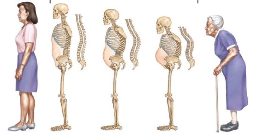 Bệnh loãng xương thường gặp ở người cao tuổi hình ảnh
