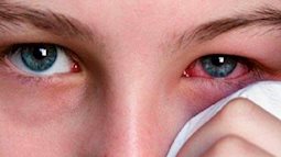 Mùa World Cup: Cẩn trọng với vết máu đỏ trong mắt khi xem bóng liên tục