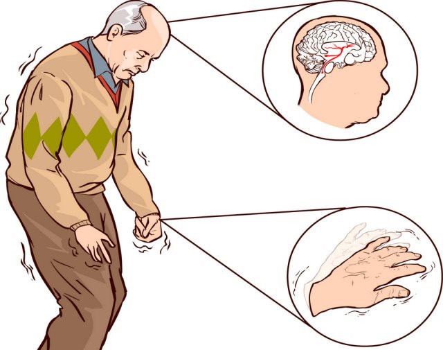 Giảm khả năng mắc bệnh Parkinson hình ảnh