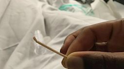 Bác sĩ Sản khoa giải tỏa nỗi lo “cấy que tránh thai bị chui lên tim, phổi”