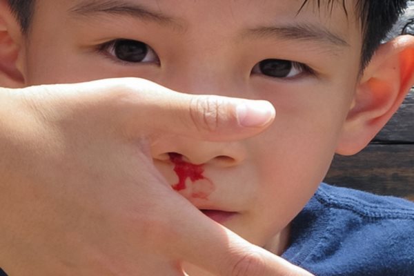 Trẻ nhỏ là đối tượng rất dễ bị chảy máu cam hình ảnh