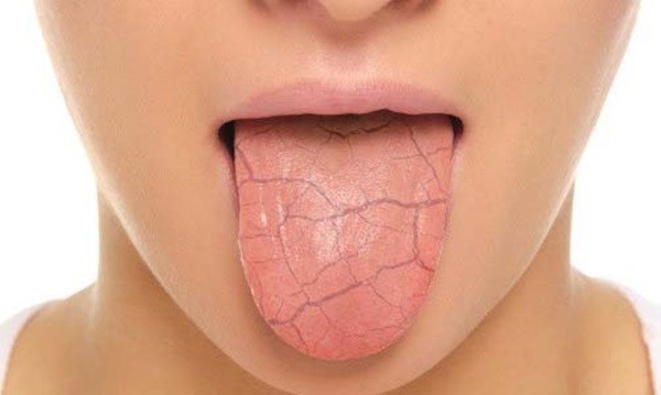 Khô miệng là một trong nhiều cách cơ thể báo hiệu chúng cần nước.