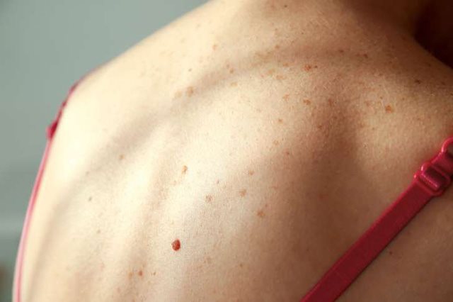 Ung thư da là một trong những biến chứng nguy hiểm nhất của viêm da hình ảnh