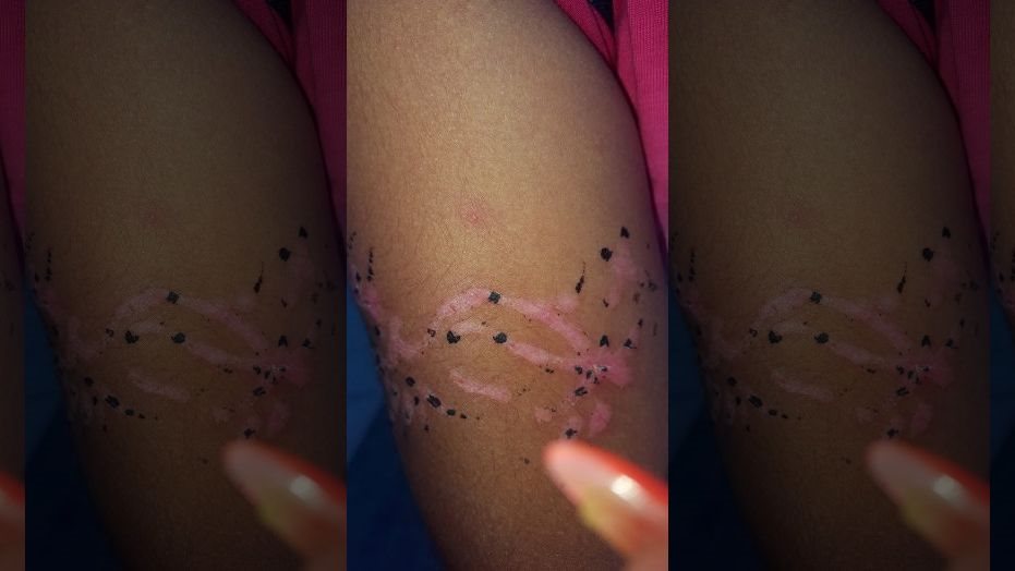 Xăm henna có thể để lại sẹo và nguy hiểm với trẻ nhỏ hình ảnh