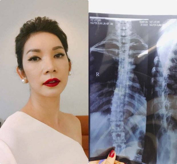 Là một trong những người mẫu hàng đầu của làng thời trang Việt, siêu mẫu Xuân lan bất ngờ tiết lộ mình bị cong vẹo cột sống, phải đi trị liệu khiến khán giả và fan hâm mộ lo lắng.
