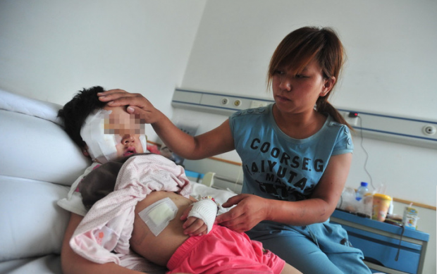 Bé gái bị chó ngao Tây Tạng cắn bị thương nghiêm trọng ở mặt.