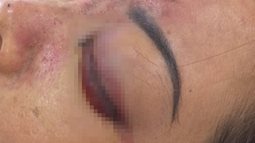 Tiêm filler tại spa khiến một phụ nữ bị mù mắt