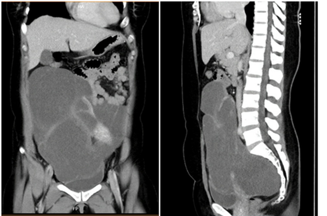 Hình CT scan khối u chiếm gần toàn bộ ổ bụng, từ vùng chậu lên đến sát gan