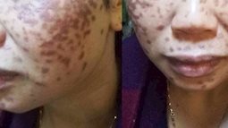 Trị nám bằng axit ở spa, một phụ nữ bị bỏng da nặng