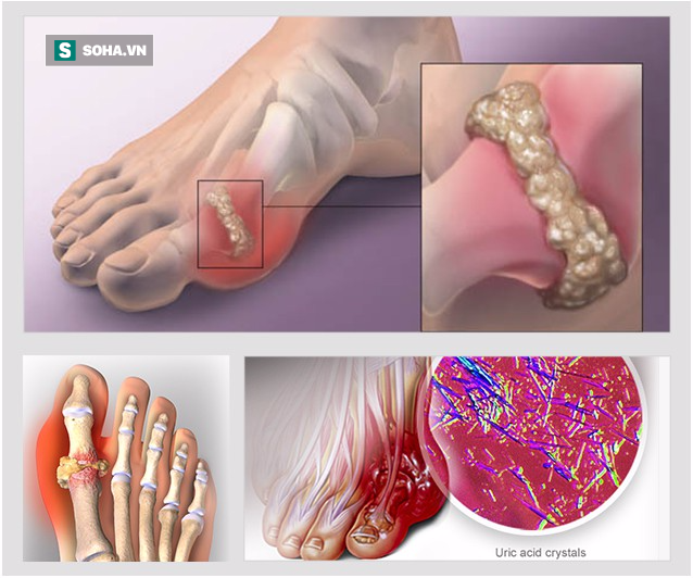 Nhiều người vô tình làm những việc này, đến khi đau không đi nổi mới biết bị mắc bệnh gút - Ảnh 1.