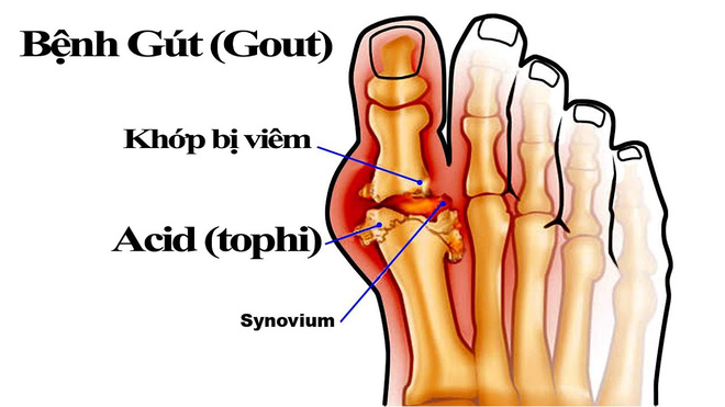 Nhiều người vô tình làm những việc này, đến khi đau không đi nổi mới biết bị mắc bệnh gút - Ảnh 3.