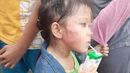 Bảo mẫu đánh trẻ sưng mặt ở Sài Gòn khai gì?