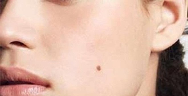 Cô gái 26 tuổi bị ung thư da sau khi làm việc này với nốt ruồi, bác sĩ cảnh báo những dấu hiệu ở nốt ruồi cần đi khám gấp - Ảnh 3.