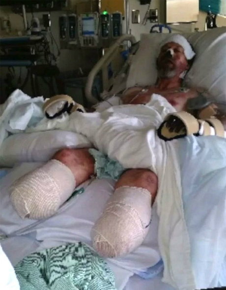 Vì bị chó liếm, Greg Manteufel phải cắt bỏ hai chân, sau đó đến hai tay. Ảnh: People.