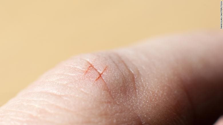 Tại sao vết cắt do giấy cứa vào ngón tay lại đau đến vậy? hình ảnh