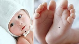 Nốt ruồi mọc không bình thường ở trẻ thực sự đáng lo ngại hơn bạn nghĩ