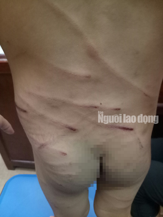 Giải cứu bé trai 3 tuổi bị cha dượng đánh dã man ở Phú Quốc - Ảnh 2.