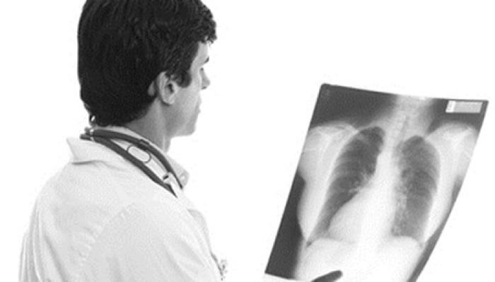 Ung thư phổi di căn xương nguy hiểm như thể nào?