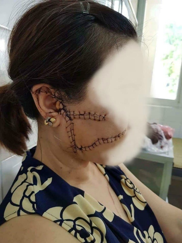 Bắc Giang: Chỉ vì ghen tuông, chồng nhẫn tâm dùng dao rạch nát mặt vợ 